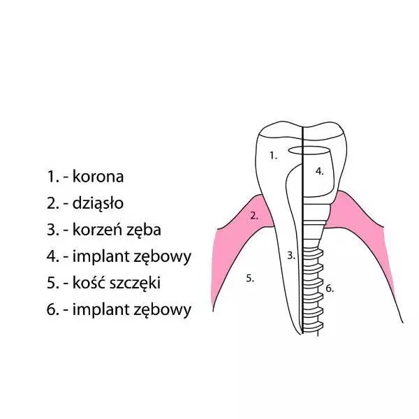 implanty stomatologiczne Łódź