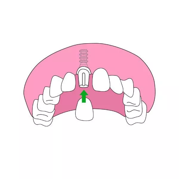 implanty zębowe Łódź