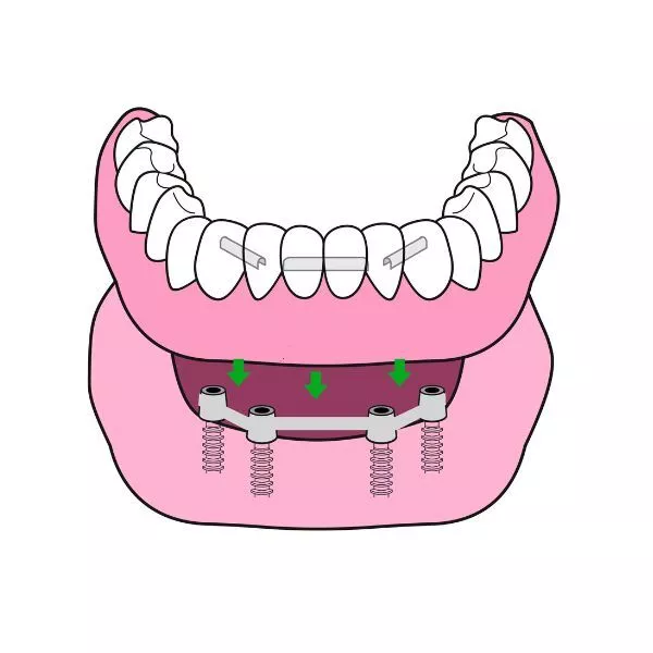 implant zęba Łódź