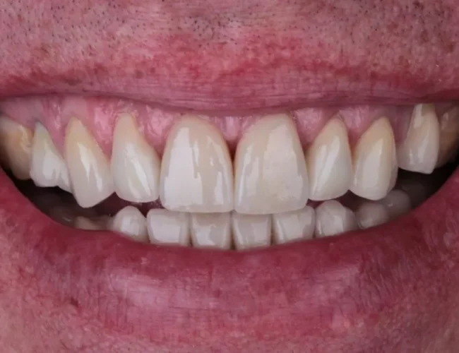 Krok po kroku do implantów zębów