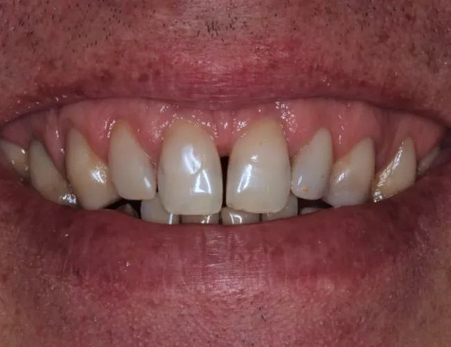 Krok po kroku do implantów zębów
